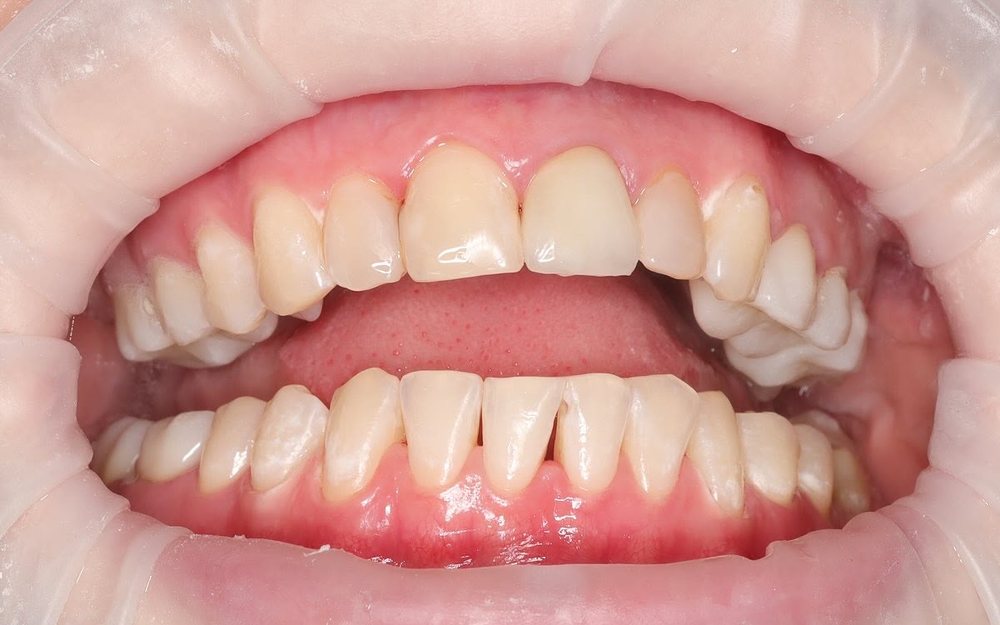 Teeth after treatment