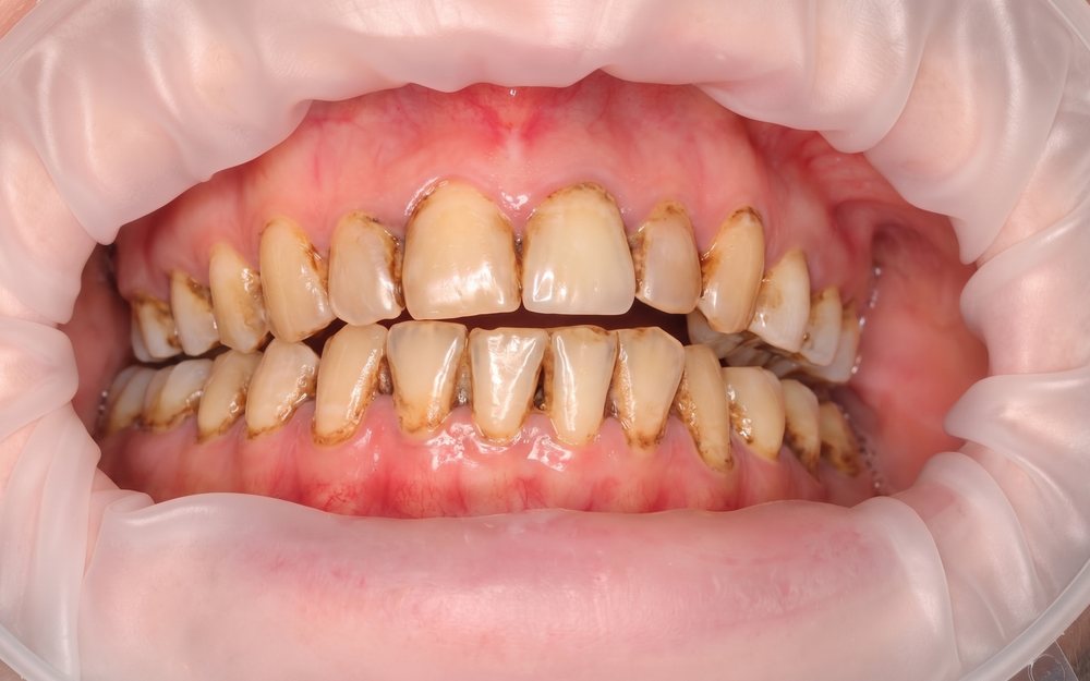Teeth before treatment